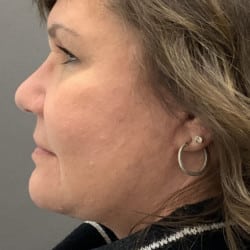 After Image: Facelift and Upper Blepharoplasty by Dr. Thompson - left-side