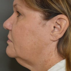 Before Image: Facelift and Upper Blepharoplasty by Dr. Thompson - left-side
