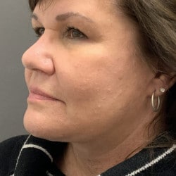 After Image: Facelift and Upper Blepharoplasty by Dr. Thompson - left-front-oblique