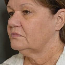 Before Image: Facelift and Upper Blepharoplasty by Dr. Thompson - left-front-oblique