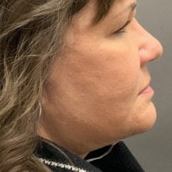 After Image: Facelift and Upper Blepharoplasty by Dr. Thompson - right-side