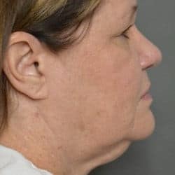 Before Image: Facelift and Upper Blepharoplasty by Dr. Thompson - right-side