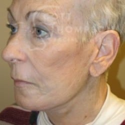 After Image: Facelift Before and After Photos | Utah Facial Plastics 288 - left-front-oblique