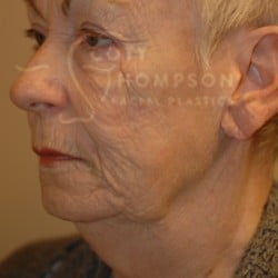 Before Image: Facelift Before and After Photos | Utah Facial Plastics 288 - left-front-oblique