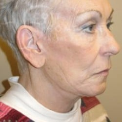 After Image: Facelift Before and After Photos | Utah Facial Plastics 288 - right-front-oblique