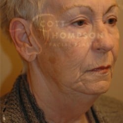 Before Image: Facelift Before and After Photos | Utah Facial Plastics 288 - right-front-oblique