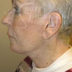 After Image: Facelift Before and After Photos | Utah Facial Plastics 288 - left-side