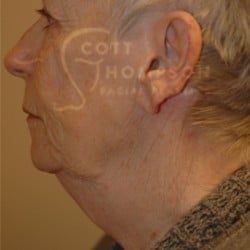 Before Image: Facelift Before and After Photos | Utah Facial Plastics 288 - left-side