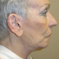 After Image: Facelift Before and After Photos | Utah Facial Plastics 288 - right-side