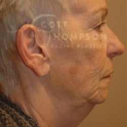 Before Image: Facelift Before and After Photos | Utah Facial Plastics 288 - right-side