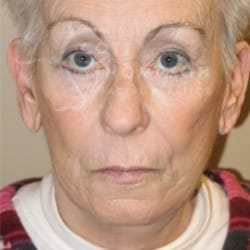 After Image: Facelift Before and After Photos | Utah Facial Plastics 288 - front