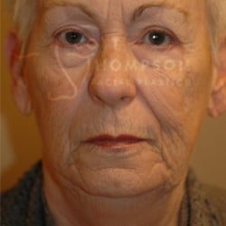Before Image: Facelift Before and After Photos | Utah Facial Plastics 288 - front