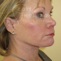 After Image: Facelift Before and After Photos | Utah Facial Plastics 301 - right-front-oblique