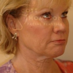 Before Image: Facelift Before and After Photos | Utah Facial Plastics 301 - right-front-oblique