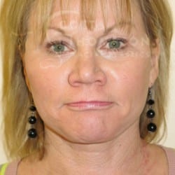 After Image: Facelift Before and After Photos | Utah Facial Plastics 301 - right-front-oblique