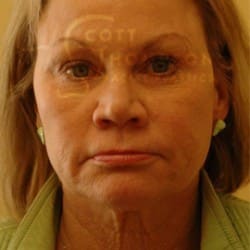 Before Image: Facelift Before and After Photos | Utah Facial Plastics 301 - right-front-oblique