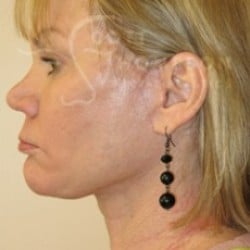 After Image: Facelift Before and After Photos | Utah Facial Plastics 301 - left-side