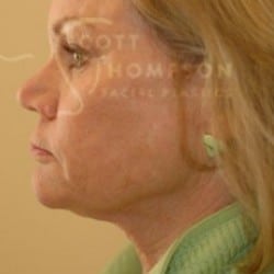 Before Image: Facelift Before and After Photos | Utah Facial Plastics 301 - left-side
