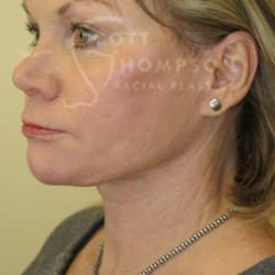 After Image: Facelift Before and After Photos | Utah Facial Plastics 301 - left-front-oblique