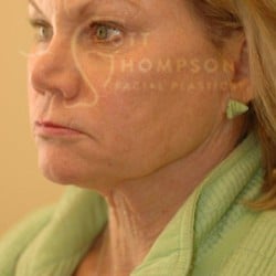 Before Image: Facelift Before and After Photos | Utah Facial Plastics 301 - left-front-oblique