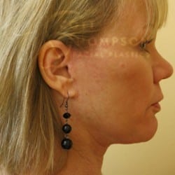After Image: Facelift Before and After Photos | Utah Facial Plastics 301 - right-side