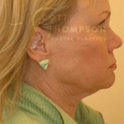 Before Image: Facelift Before and After Photos | Utah Facial Plastics 301 - right-side
