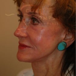 After Image: Facelift Before and After Photos | Utah Facial Plastics 303 - left-front-oblique