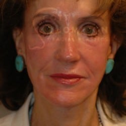 After Image: Facelift Before and After Photos | Utah Facial Plastics 303 - front