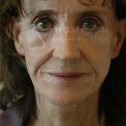 Before Image: Facelift Before and After Photos | Utah Facial Plastics 303 - front