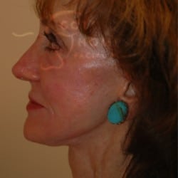 After Image: Facelift Before and After Photos | Utah Facial Plastics 303 - left-side
