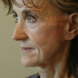 Before Image: Facelift Before and After Photos | Utah Facial Plastics 303 - left-front-oblique