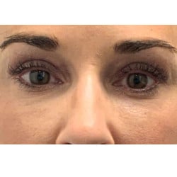 After Image: Periorbital Fat Injections by Dr. Henstrom