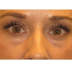 Before Image: Periorbital Fat Injections by Dr. Henstrom