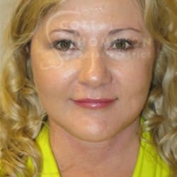 After Image: Facelift and Upper Blepharoplasty by Dr. Thompson - front