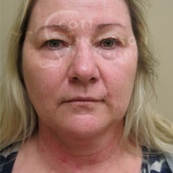 Before Image: Facelift and Upper Blepharoplasty by Dr. Thompson - front