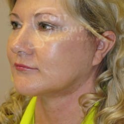 After Image: Facelift and Upper Blepharoplasty by Dr. Thompson - left-front-oblique