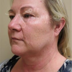 Before Image: Facelift and Upper Blepharoplasty by Dr. Thompson - left-front-oblique