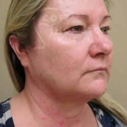 Before Image: Facelift and Upper Blepharoplasty by Dr. Thompson - right-front-oblique