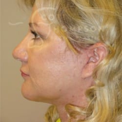 After Image: Facelift and Upper Blepharoplasty by Dr. Thompson - left-side