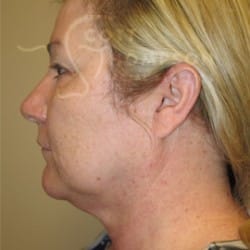 Before Image: Facelift and Upper Blepharoplasty by Dr. Thompson - left-side