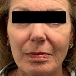 After Image: Fat Transfer by Dr. Thompson - front