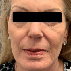 Before Image: Fat Transfer by Dr. Thompson - front