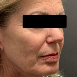 After Image: Fat Transfer by Dr. Thompson - right-front-oblique