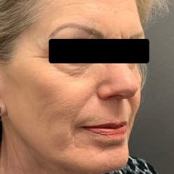 Before Image: Fat Transfer by Dr. Thompson - right-front-oblique