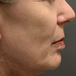 After Image: Fat Transfer by Dr. Thompson - right-side