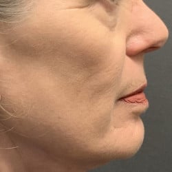 Before Image: Fat Transfer by Dr. Thompson - right-side