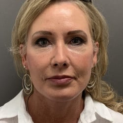 After Image: Facelift and Upper Blepharoplasty by Dr. Henstrom - front