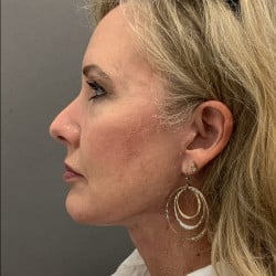 After Image: Facelift and Upper Blepharoplasty by Dr. Henstrom - left-side