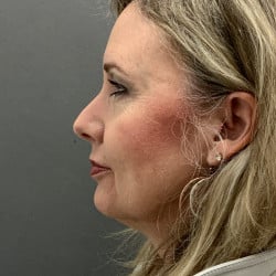 Before Image: Facelift and Upper Blepharoplasty by Dr. Henstrom - left-side