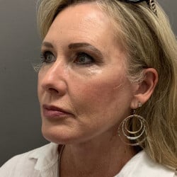 After Image: Facelift and Upper Blepharoplasty by Dr. Henstrom - left-front-oblique
